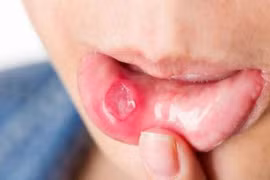 Cách phòng tái phát loét miệng