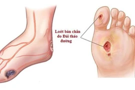 Kiểm soát biến chứng nặng của tiểu đường 