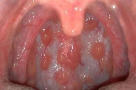 Nhận biết sớm viêm họng hạt 