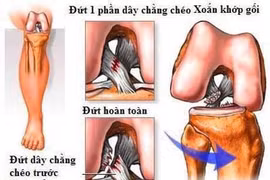 Đau gối: Cẩn thận đứt dây chằng chéo trước khớp