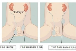 Tinh hoàn lò xo không điều trị thành tinh hoàn ẩn