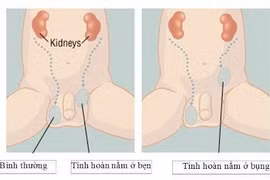 Tinh hoàn lò xo không điều trị thành tinh hoàn ẩn
