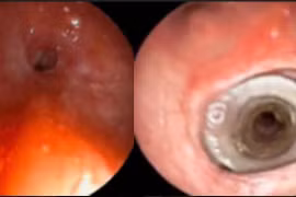 Cấp cứu bệnh nhân suy hô hấp cấp do hẹp khí quản