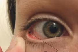 Không được coi thường dị vật bay vào mắt