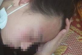 Đi mua kim, nữ sinh lớp 10 bị đánh chấn động não
