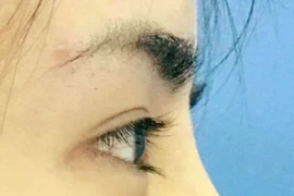 Những điều cần biết khi phẫu thuật nâng mũi