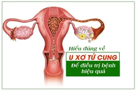 Hiểu đúng về u xơ tử cung để điều trị bệnh hiệu quả