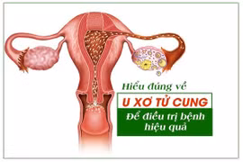 Hiểu đúng về u xơ tử cung để điều trị bệnh hiệu quả