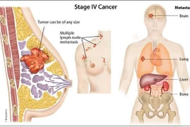 Các loại ung thư di căn tới vú