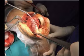 Đau nhức đùi do u đại bào