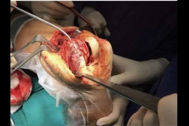 Đau nhức đùi do u đại bào