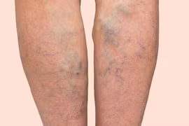 Suy giãn tĩnh mạch