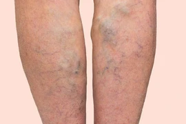 Suy giãn tĩnh mạch