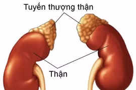 Suy tuyến thượng thận vì lạm dụng corticoid