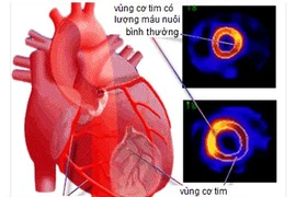 Tiêm phóng xạ vào tim để chẩn đoán