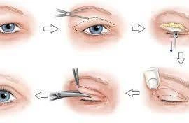 Những rủi ro khi phẫu thuật tạo hình mí mắt