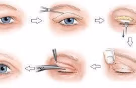Những rủi ro khi phẫu thuật tạo hình mí mắt