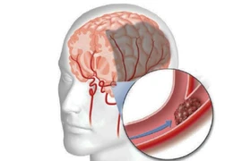 Người cao tuổi nên phục hồi chức năng sau tai biến mạch máu não như thế nào?