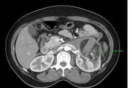 Nút mạch hạt vi cầu điều trị u cơ mỡ mạch thận vỡ