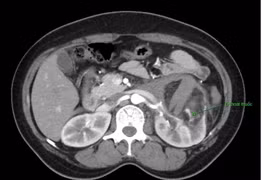 Nút mạch hạt vi cầu điều trị u cơ mỡ mạch thận vỡ