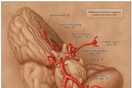 Sự ác hiểm của phình động mạch não