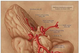 Sự ác hiểm của phình động mạch não