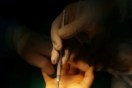 Nội soi điều trị hội chứng ống cổ tay 