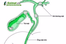 Tránh tái phát sau mổ sỏi đường mật