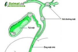 Tránh tái phát sau mổ sỏi đường mật