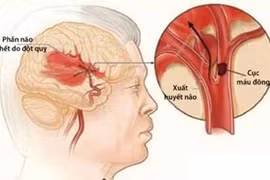 Kiểm soát tốt đột quỵ não 
