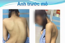 Phẫu thuật chỉnh hình cột sống cong 45 độ 