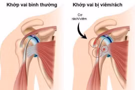 Bài tập phục hồi đau vai do viêm gân chóp xoay