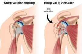 Bài tập phục hồi đau vai do viêm gân chóp xoay