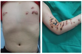 Loét da sâu không khỏi sau khi tiếp xúc với sứa biển