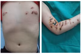 Loét da sâu không khỏi sau khi tiếp xúc với sứa biển