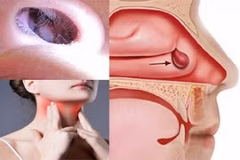 Nghi ngờ ung thư mũi xoang người bệnh cần làm các xét nghiệm nào? 