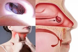 Nghi ngờ ung thư mũi xoang người bệnh cần làm các xét nghiệm nào? 