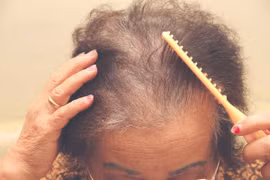 Rụng tóc không liên quan đến mùa thu