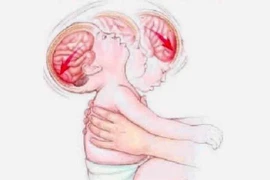 Não trẻ bị ảnh hưởng nghiêm trọng thế nào khi bị rung lắc, quăng quật?