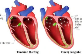 Nguy cơ của rung nhĩ vô căn