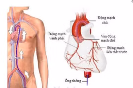 Đau ngực, choáng ngất do hẹp van động mạch chủ