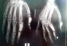 Xương chảy nến