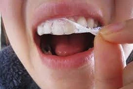 Tẩy trắng răng siêu tốc rất độc hại