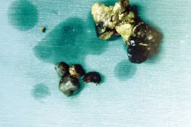 Mất thận vì uống lá tiêu sỏi 