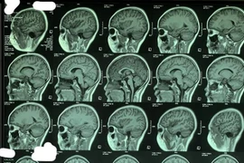 Tưởng con bị hậu COVID-19 nào ngờ giun đũa chó mèo trong não