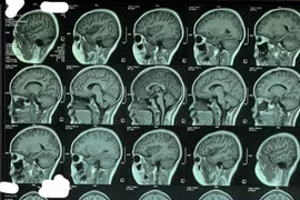 Tưởng con bị hậu COVID-19 nào ngờ giun đũa chó mèo trong não