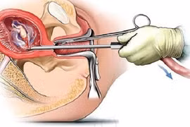 Mỗi năm Hà Nội giảm 2/3 số vị thành niên, thanh niên có thai ngoài ý muốn