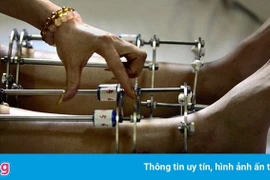 Tay lệch muốn kéo dài