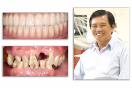 Giải pháp tối ưu trong điều trị mất răng toàn hàm từ nghiên cứu khoa học của TS Trần Hùng Lâm