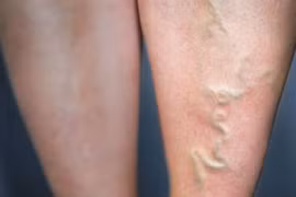 Chọn tất cho người giãn tĩnh mạch chân